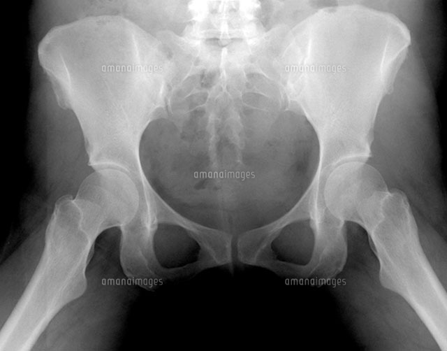 骨盤骨付近のX線写真[01808015740A]の写真・イラスト素材｜アマナ